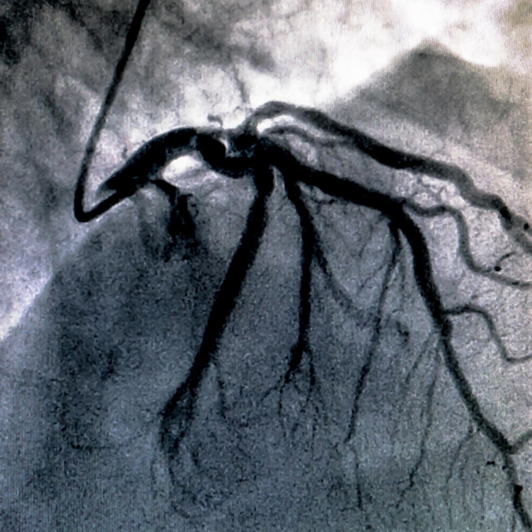 Cardiac MRI
