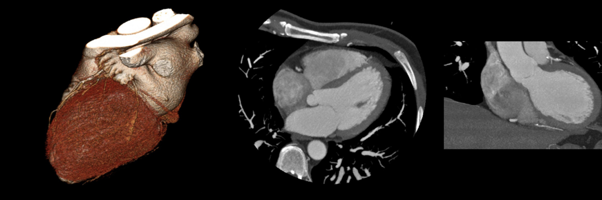 Advanced Cardiac Imaging