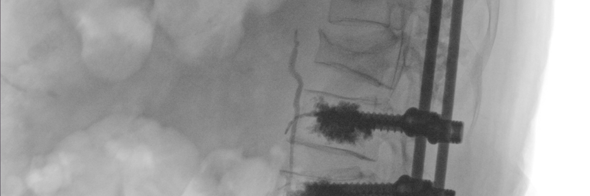 Back & Spine Surgery