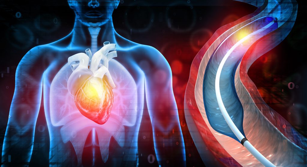 Balloon angioplasty procedure with stent in vein.3d illustration