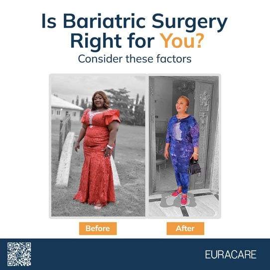 images of a woman showing her physical state before and after a bariatric surgery
